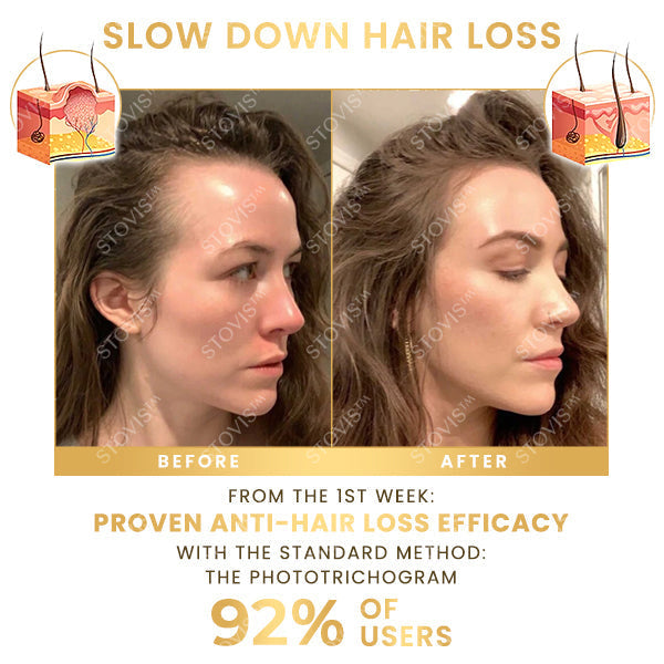 Stovis™ Biotin Hair Booster 🔥